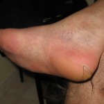 Blister treatment 1