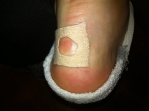 Blister treatment 2